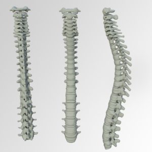 How to Relieve Back Pain Through Spinal Cord Stimulation