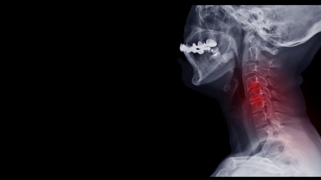 What are the Leading Causes of Cervical Spondylosis