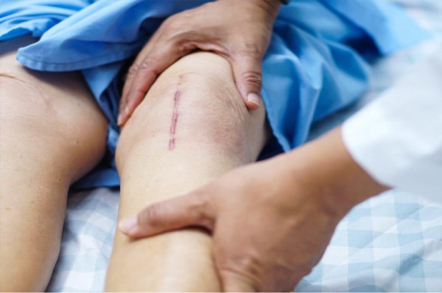 Tips for Faster Recovery from Knee Surgery