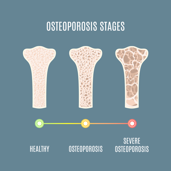What is the Most Effective Treatment for Osteoporosis